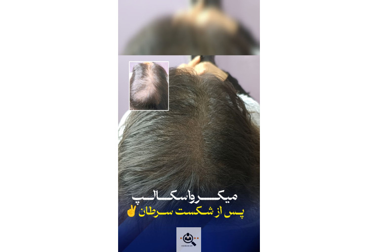 میکرواسکالپ مریم درویشی در اهواز