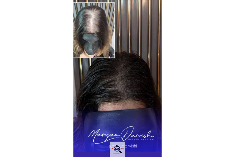 میکرواسکالپ مریم درویشی در اهواز