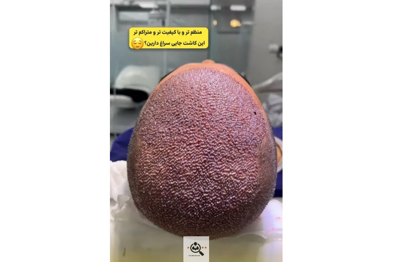 کاشت مو سقایت در شیراز