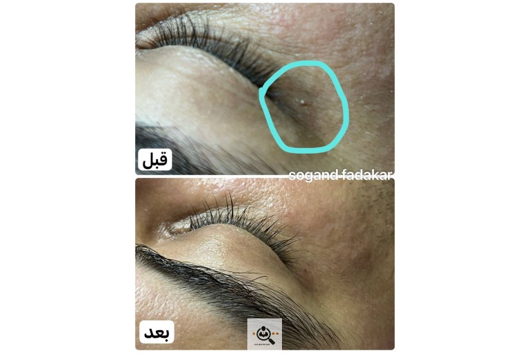 فیشال و پاکسازی صورت سوگند فداکار در تهران