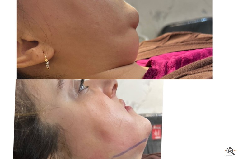 بهترین جراحی و عمل بینی در رشت - دکتر نفیسه صادق زاده