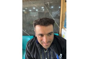 کاشت مو سارا حسینی در شاهرود