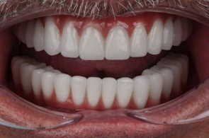 پروتز دندانی و لمینت نبی زاده در تبریز