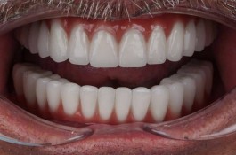 پروتز دندانی و لمینت نبی زاده در تبریز
