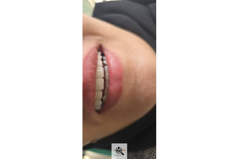 پروتز دندانی و لمینت نبی زاده در تبریز