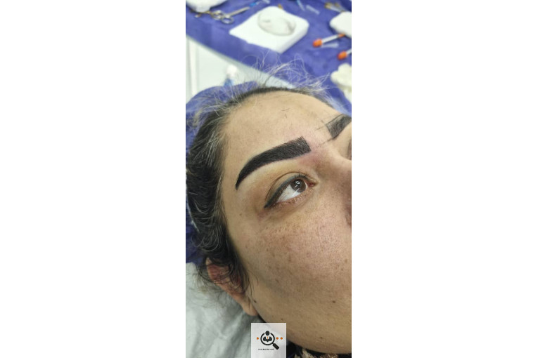 کاشت ابرو مددی در مشهد