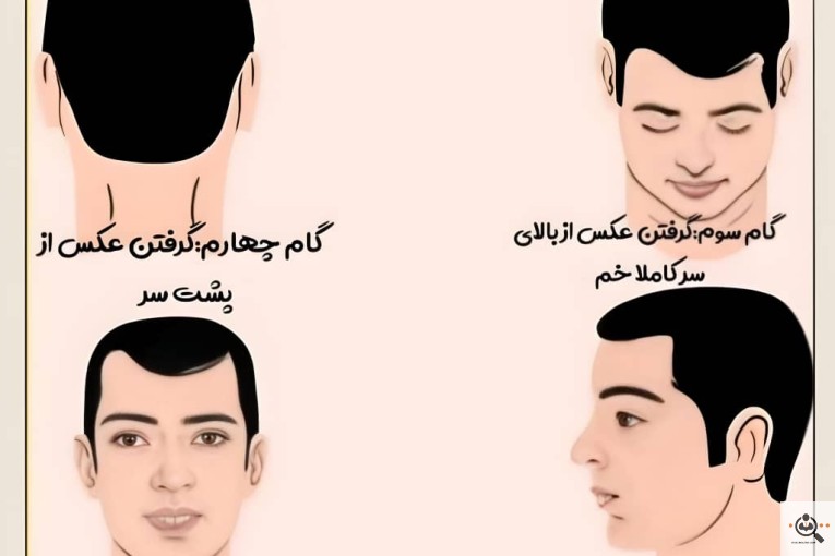 کاشت مو شهلا دهقانی در شیراز
