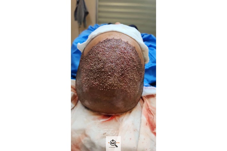 بهترین و پر تراکم ترین کاشت ابرو و مو و به خواب ابرو در اهواز