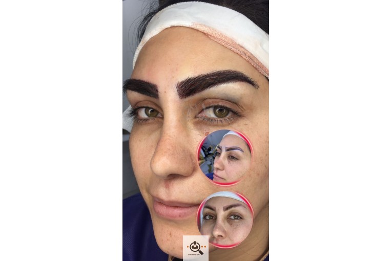 بهترین و پر تراکم ترین کاشت ابرو و مو و به خواب ابرو در اهواز