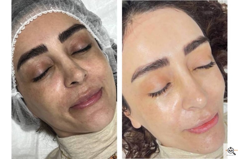 فیشال صورت عاطفه امیری در غرب تهران