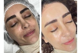 فیشال صورت عاطفه امیری در غرب تهران