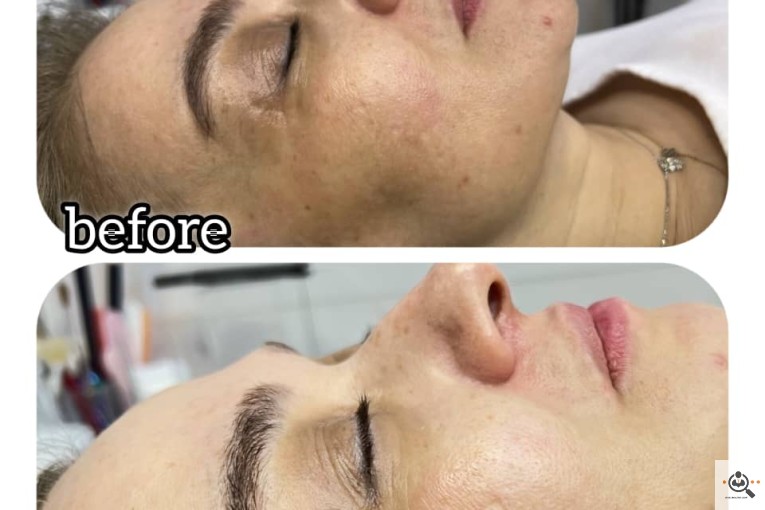 فیشال صورت عاطفه امیری در غرب تهران