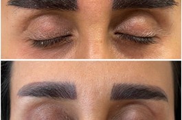 کاشت مو نعیمه اسفندیاری در قائمشهر