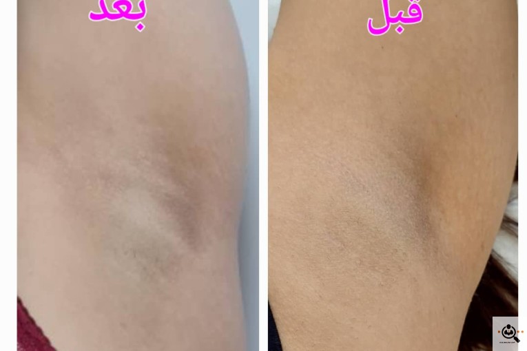 بهترین مرکز پاک کردن تاتو در ساری