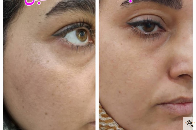 بهترین مرکز پاک کردن تاتو در ساری