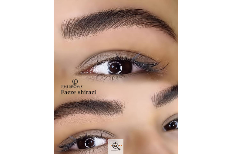 میکروبلیدینگ و فیبروز فائزه شیرازی در شیراز
