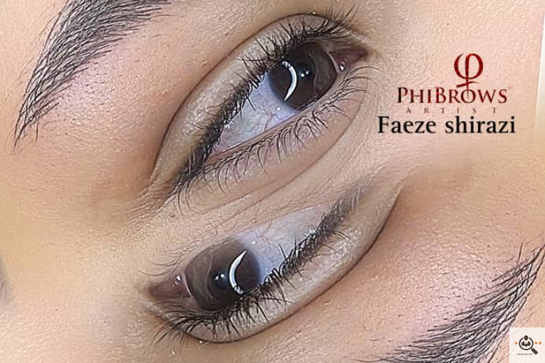 میکروبلیدینگ و فیبروز فائزه شیرازی در شیراز