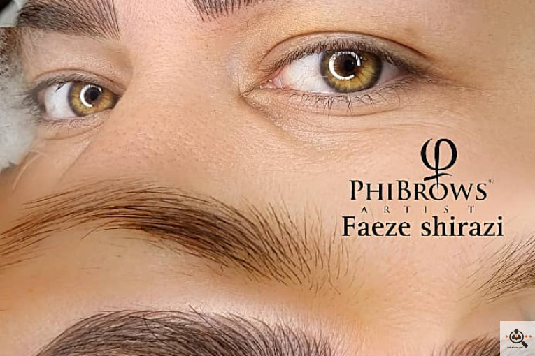 میکروبلیدینگ و فیبروز فائزه شیرازی در شیراز
