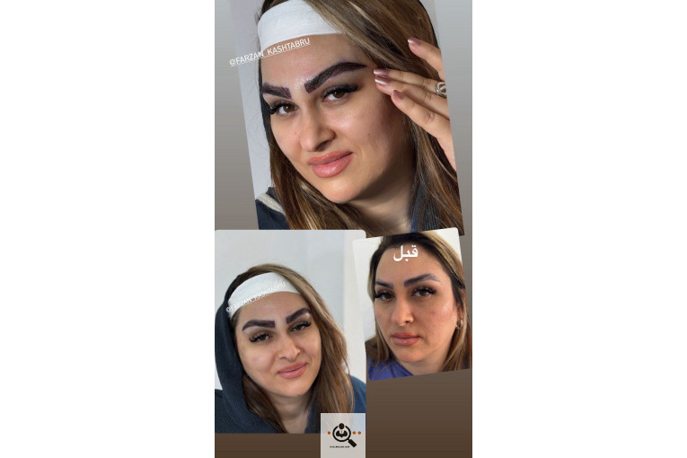کاشت ابرو حرفه ای مازندران فرزانه محمدپور