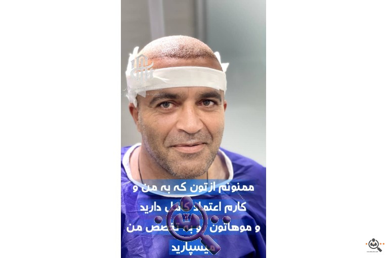 بهترین مجری و مرکز تخصصی کاشت مو در تهران و  شیراز 