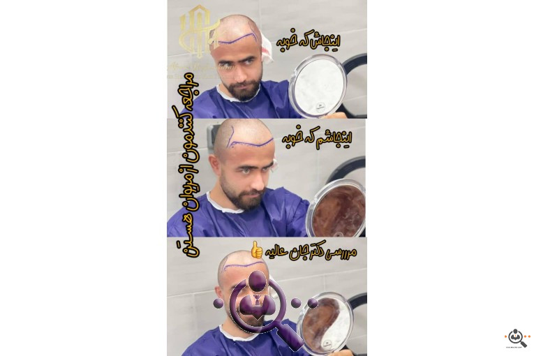 بهترین مجری و مرکز تخصصی کاشت مو در تهران و  شیراز 
