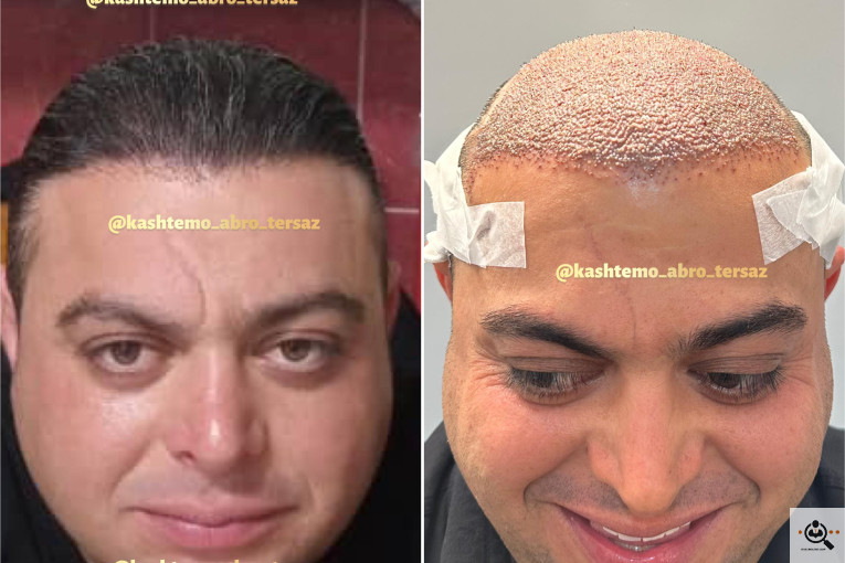 بهترین و پرتراکم و عالی ترین کاشت مو و ابرو در مازندران