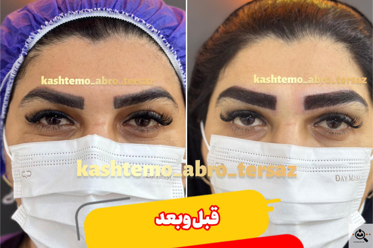 بهترین و پرتراکم و عالی ترین کاشت مو و ابرو در مازندران