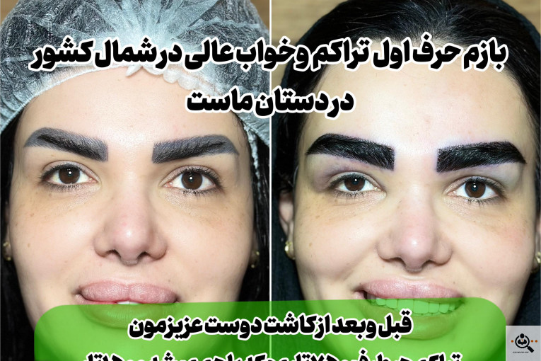 بهترین و پرتراکم و عالی ترین کاشت مو و ابرو در مازندران
