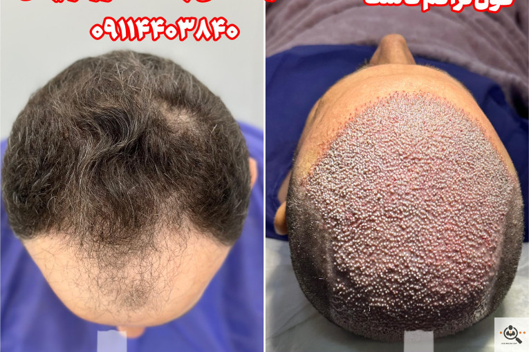 بهترین و پرتراکم و عالی ترین کاشت مو و ابرو در مازندران