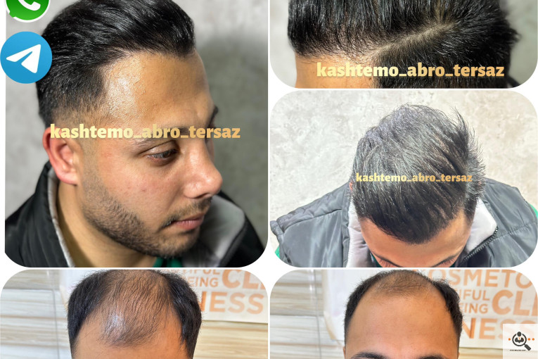 بهترین و پرتراکم و عالی ترین کاشت مو و ابرو در مازندران