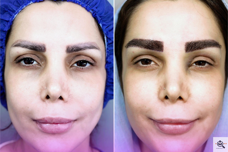 بهترین و پرتراکم و عالی ترین کاشت مو و ابرو در مازندران