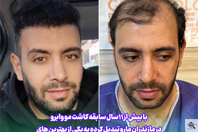 بهترین و پرتراکم و عالی ترین کاشت مو و ابرو در مازندران