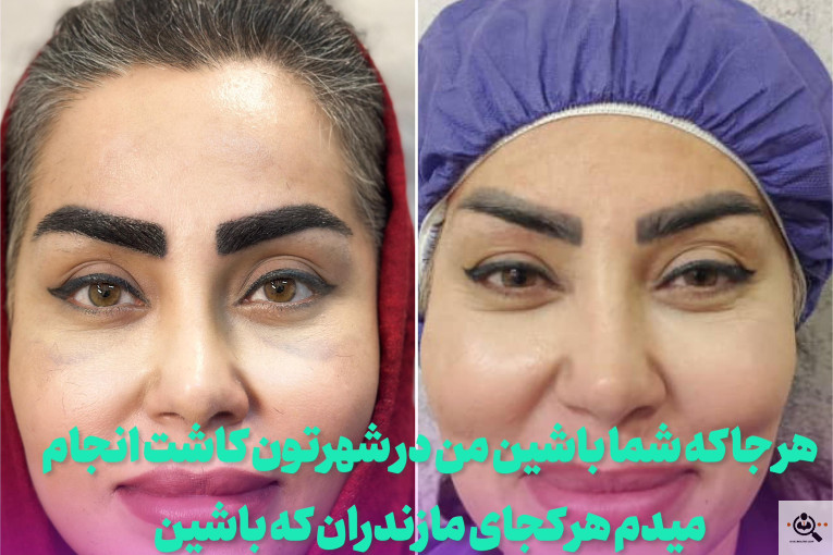 بهترین و پرتراکم و عالی ترین کاشت مو و ابرو در مازندران