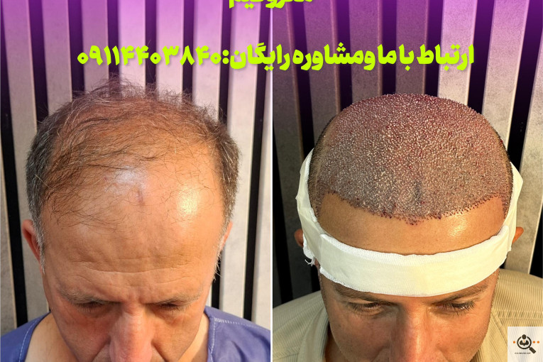 بهترین و پرتراکم و عالی ترین کاشت مو و ابرو در مازندران