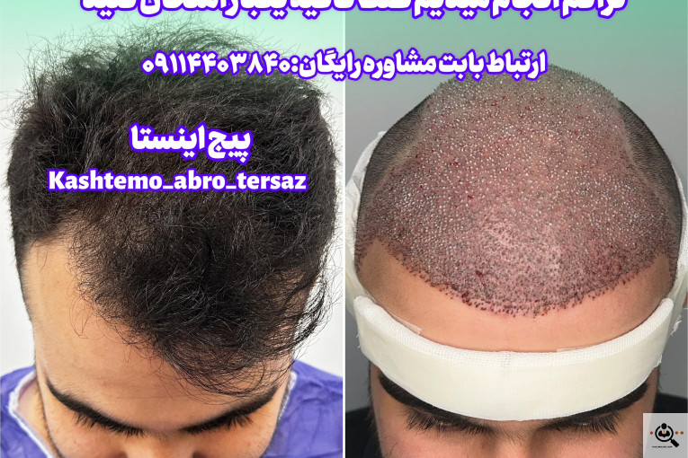 بهترین و پرتراکم و عالی ترین کاشت مو و ابرو در مازندران