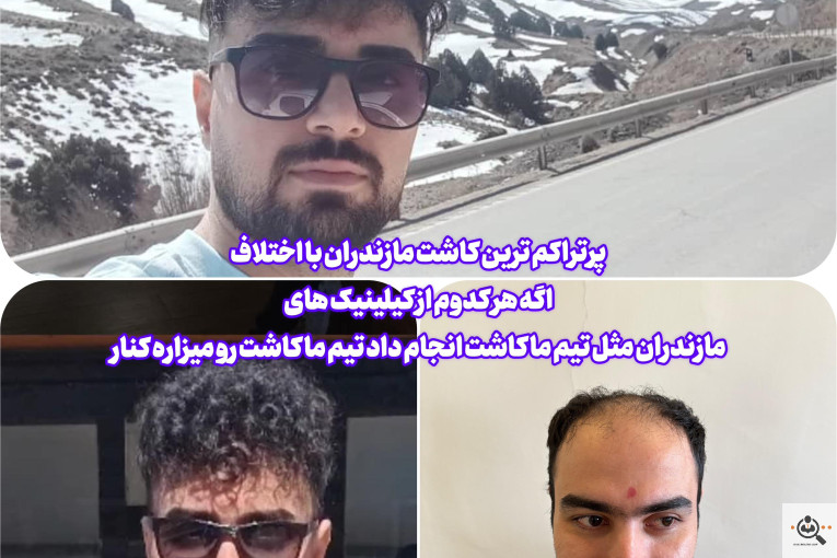 بهترین و پرتراکم و عالی ترین کاشت مو و ابرو در مازندران