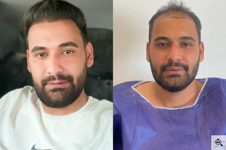 اولین و بهترین کاشت مو تخصصی در یزد