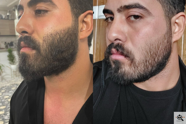 اولین و بهترین کاشت مو تخصصی در یزد