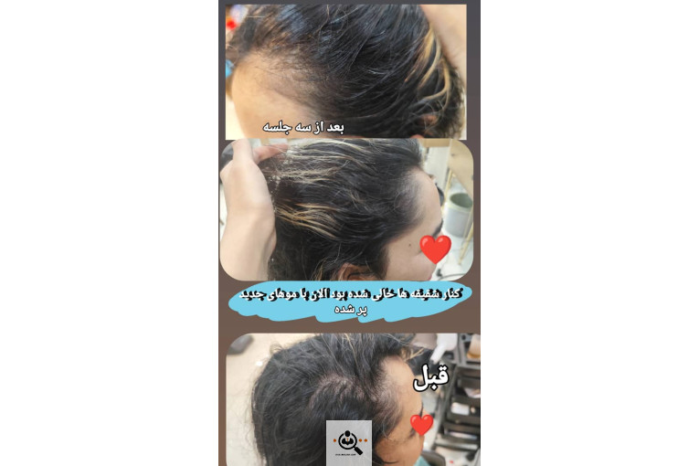 اسکراب اسکالپ سمیه شعبانی در شیراز