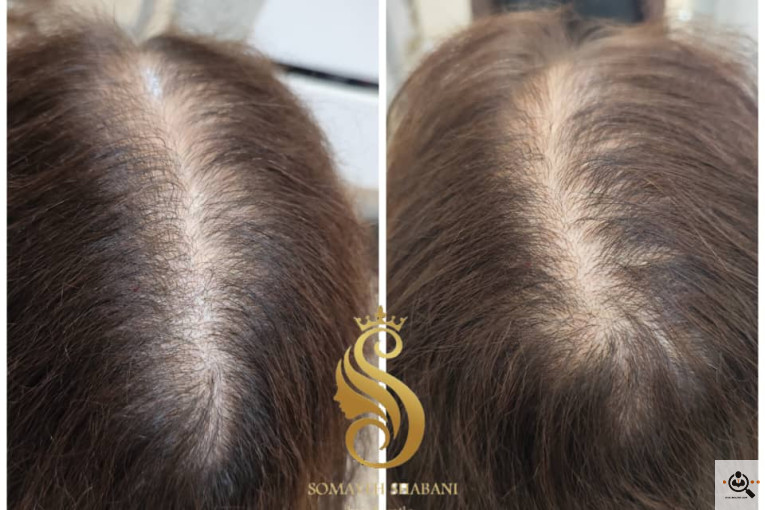 اسکراب اسکالپ سمیه شعبانی در شیراز