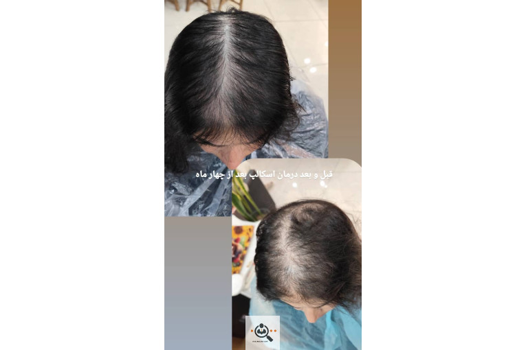 اسکراب اسکالپ سمیه شعبانی در شیراز