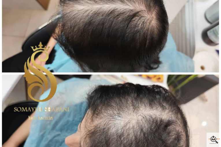 اسکراب اسکالپ سمیه شعبانی در شیراز