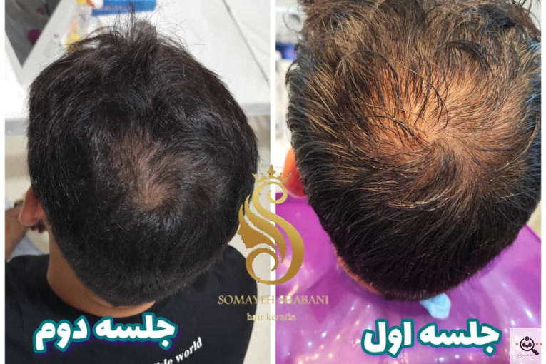 اسکراب اسکالپ سمیه شعبانی در شیراز