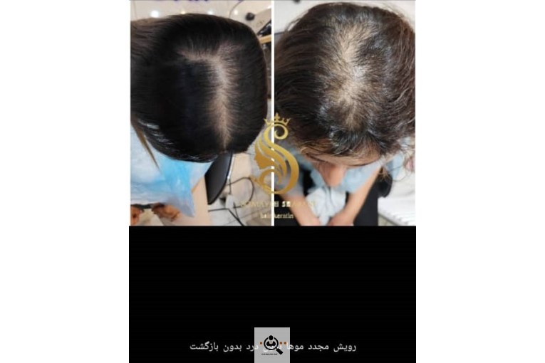 اسکراب اسکالپ سمیه شعبانی در شیراز