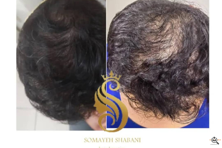 اسکراب اسکالپ سمیه شعبانی در شیراز