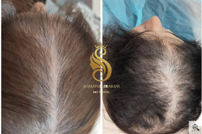 اسکراب اسکالپ سمیه شعبانی در شیراز