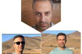 کاشت مو مریم عباسی در شیراز