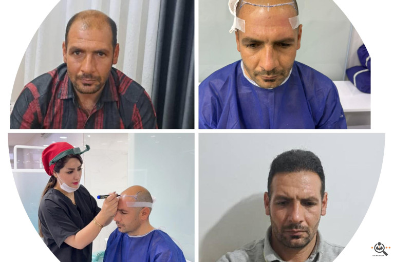 کاشت مو مریم عباسی در شیراز