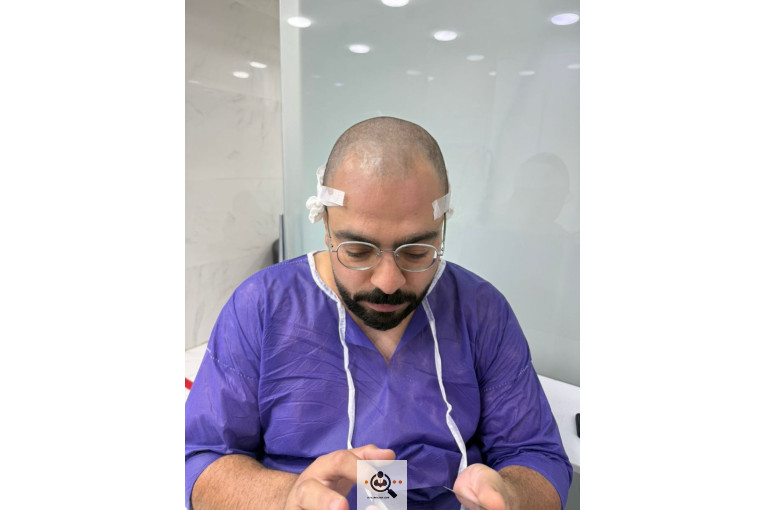 کاشت مو مریم عباسی در شیراز