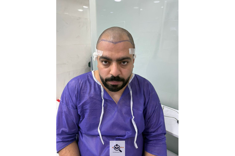 کاشت مو مریم عباسی در شیراز